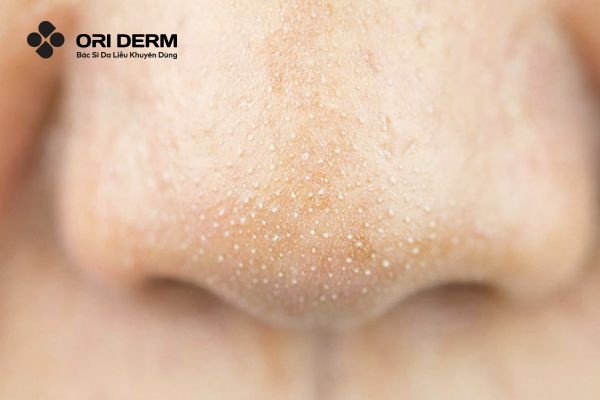 Mụn cám (Comedones)