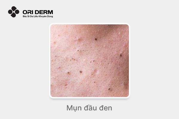 Hình ảnh mụn đầu đen