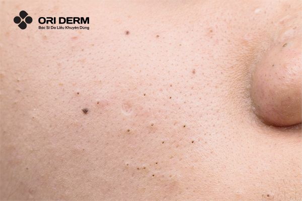 Mụn đầu đen (Blackheads)