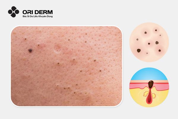 Mụn đầu đen là gì?