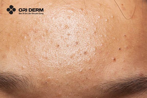 Các&nbsp;phương pháp điều trị mụn đầu đen phổ biến