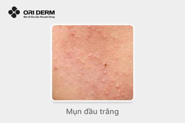 Hình ảnh mụn đầu trắng