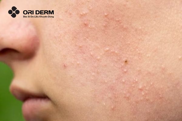 Mụn đầu trắng (Whiteheads)