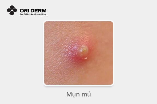 Hình ảnh mụn mủ