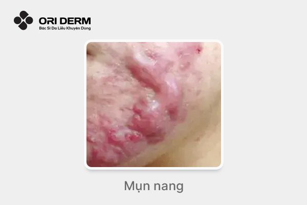 Hình ảnh mụn nang