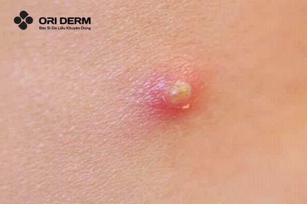 Nhọt trên da