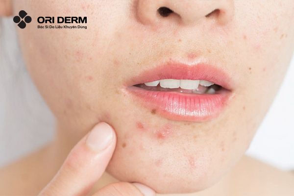 Mụn nội tiết là gì?