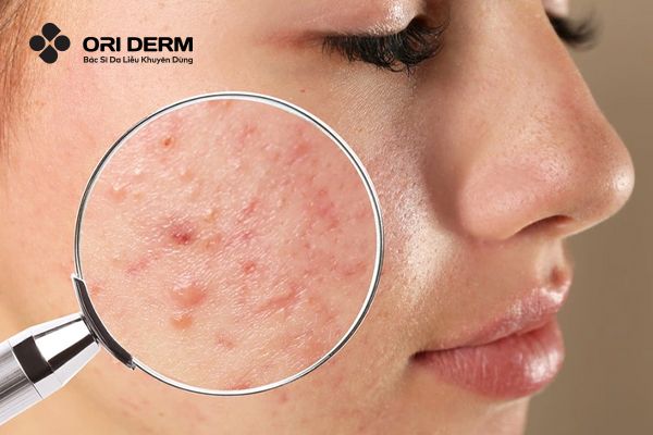 Mụn nội tiết là gì?