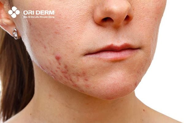 Mụn thâm tụ máu là gì?