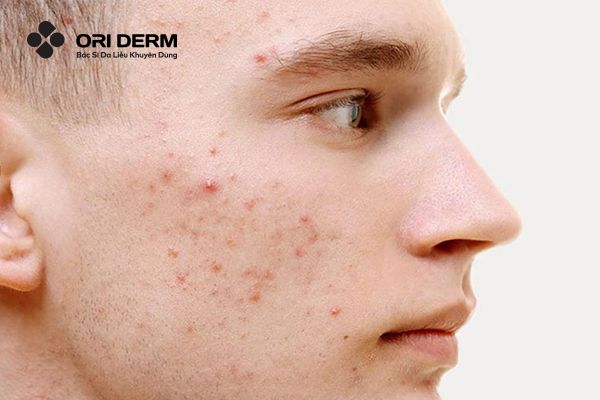 Mặt mụn trứng cá mức độ vừa