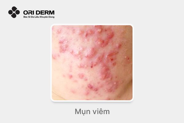Hình ảnh mụn viêm