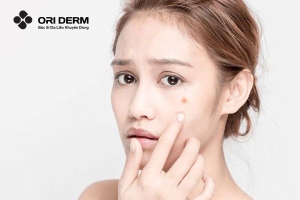 Mụn ẩn viêm dưới da có tự hết không?