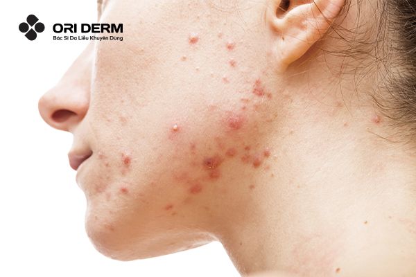 Mụn viêm là gì?