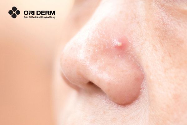 Mụn viêm ở mũi có đặc điểm gì?