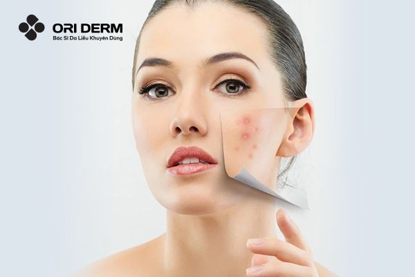 Các loại mụn viêm thường gặp