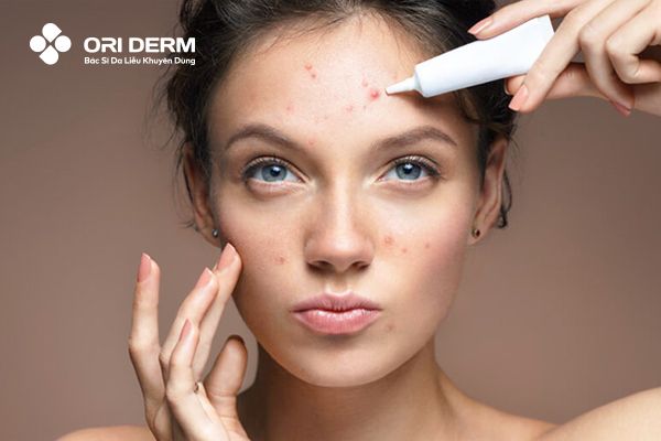 Điều trị mụn ẩn trên trán bằng thuốc bôi