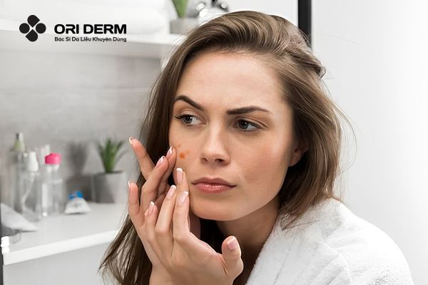 Mụn Thâm Tụ Máu: Nguyên Nhân, Cách Điều Trị Và Ngăn Ngừa