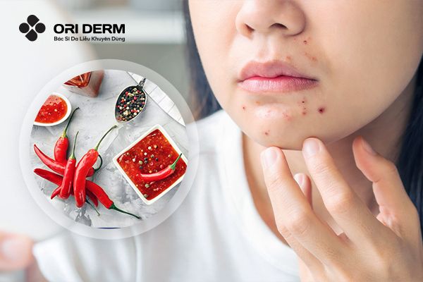Ăn Cay Có Nổi Mụn Không? Tác Động Của Ăn Cay Đến Làn Da