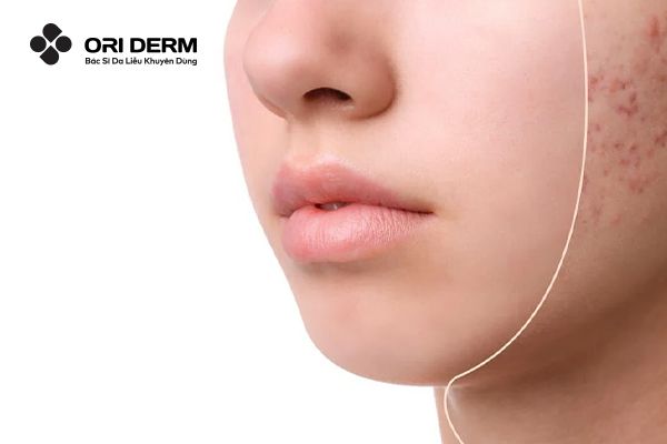 Gợi Ý Top 10 Cách Trị Sẹo Mụn Hiệu Quả An Toàn Cho Làn Da