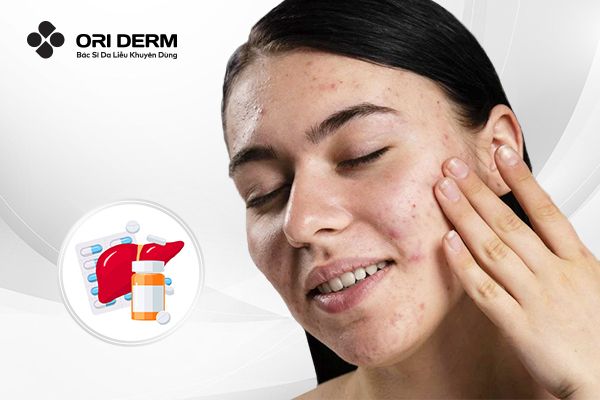 Giải Đáp: Uống Thuốc Mát Gan Có Hết Mụn Không? Nên Làm Gì Khi Bị Mụn?
