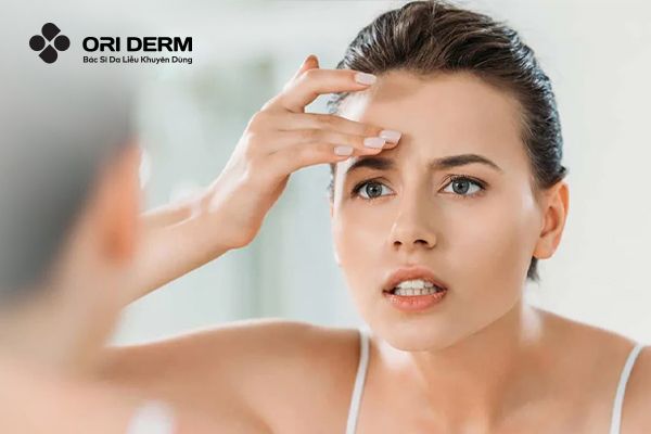 Cách ngăn ngừa mụn tái đi tái lại