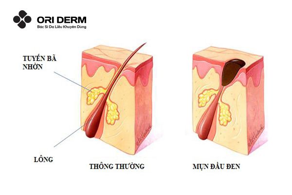 Mụn đầu đen là gì? Cơ chế hình thành của mụn đầu đen