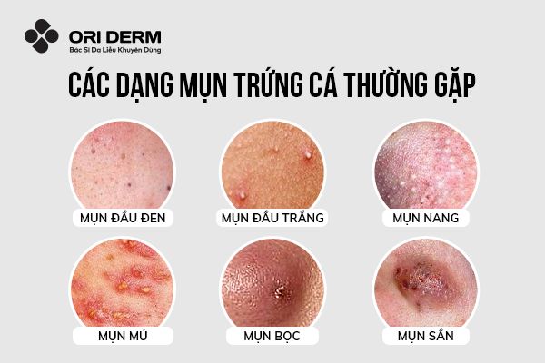 Các loại mụn trứng cá