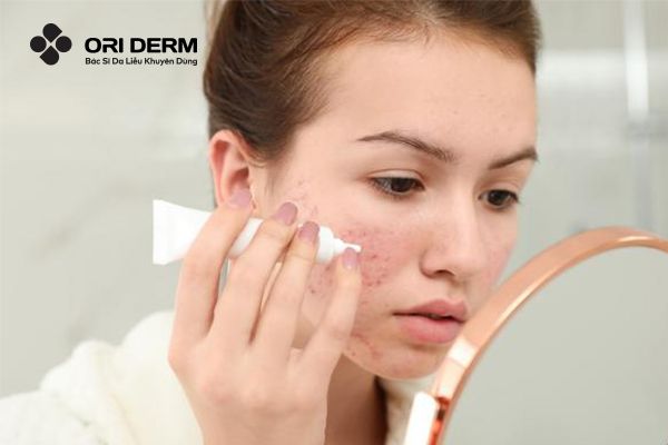 Sử dụng thuốc bôi tại chỗ