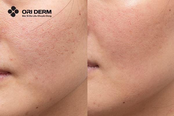 Công dụng của thuốc trị sẹo rỗ trên mặt