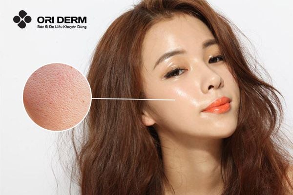 Tìm hiểu nguyên nhân bị mụn viêm ở má