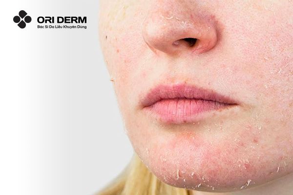 Nguyên nhân da xuất hiện tế bào chết