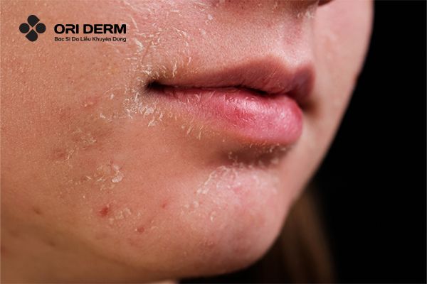 Nguyên nhân gây khô da