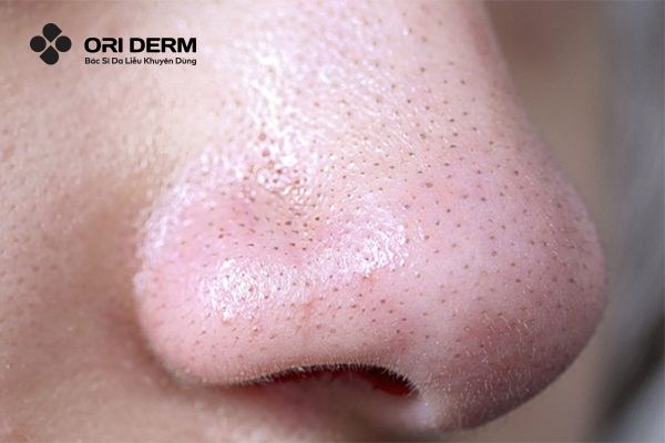 Nguyên nhân gây mụn đầu đen