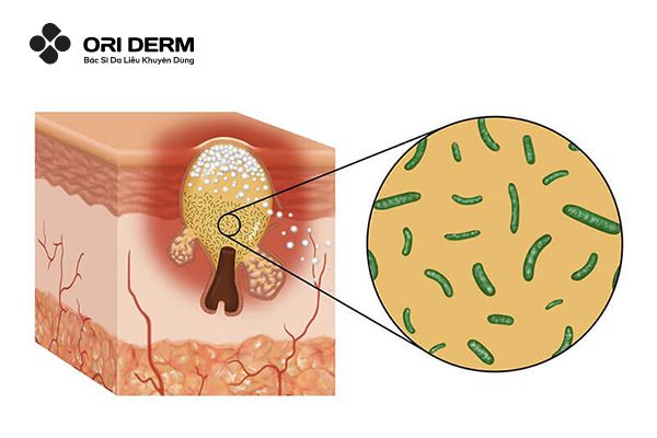 Nguyên nhân gây mụn viêm mụn mủ trắng