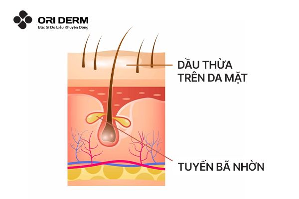 Nguyên nhân gây nhờn da mặt