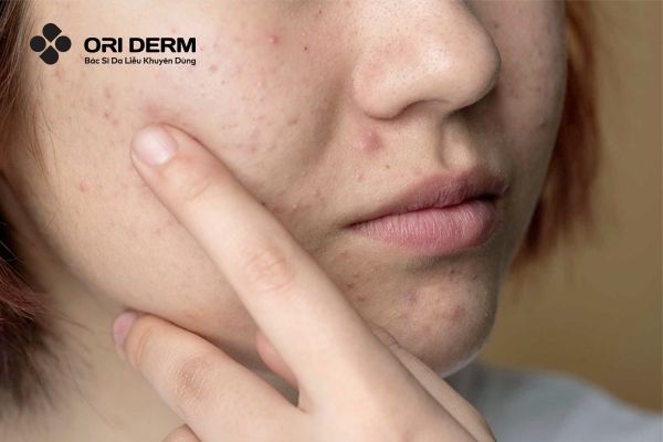 Nguyên nhân gây ra mụn ẩn