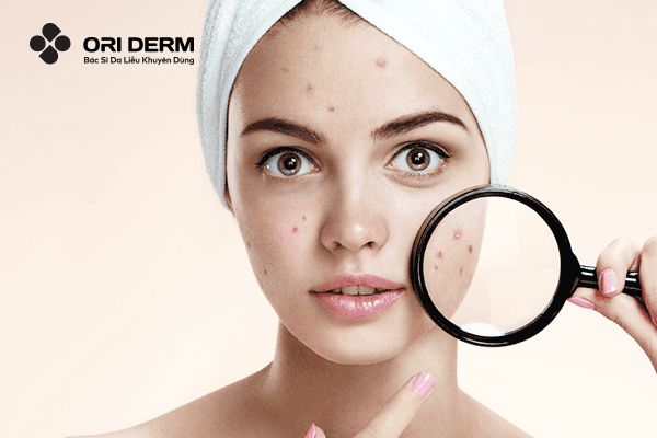 Nguyên nhân gây ra mụn ẩn