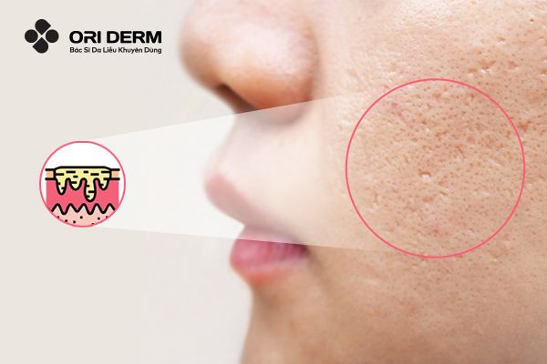 Nguyên nhân gây ra sẹo rỗ