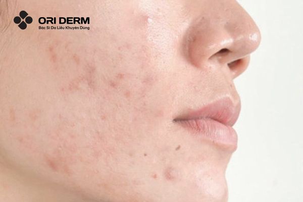 Nguyên nhân gây thâm mụn