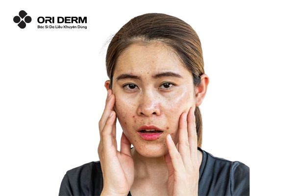 Nguyên nhân hình thành mụn viêm?