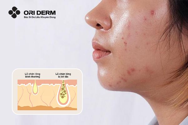 Nguyên nhân hình thành mụn