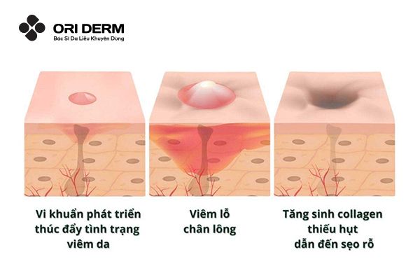 Nguyên nhân hình thành sẹo mụn