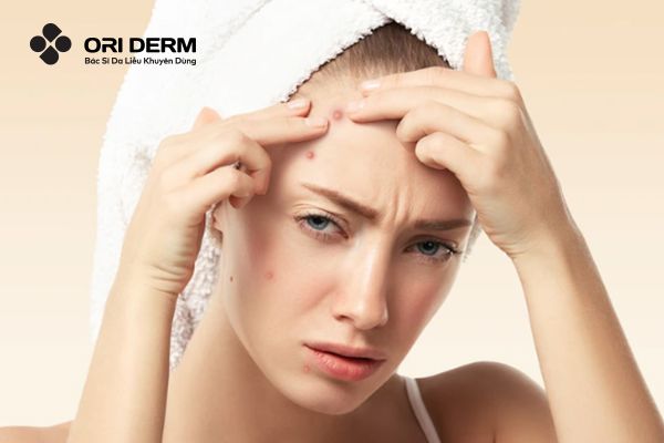 Nguyên nhân hình thành sẹo mụn