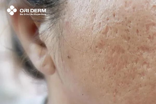 Nguyên nhân hình thành sẹo rỗ trên da