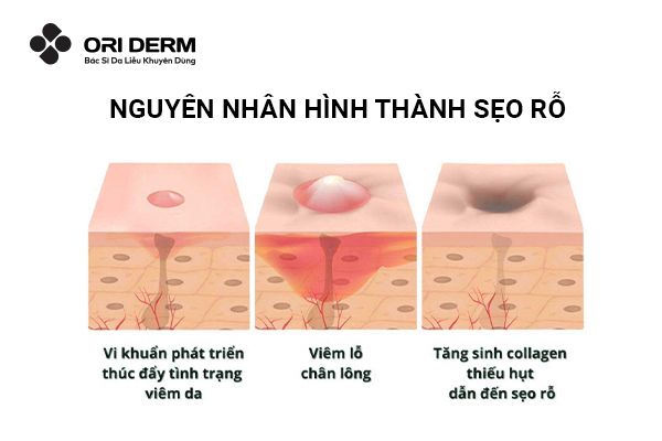 Nguyên nhân hình thành sẹo rỗ