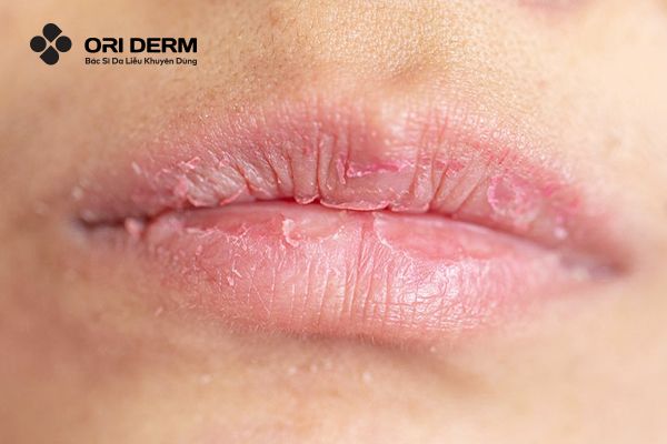 Nguyên nhân môi bị thâm, bong tróc