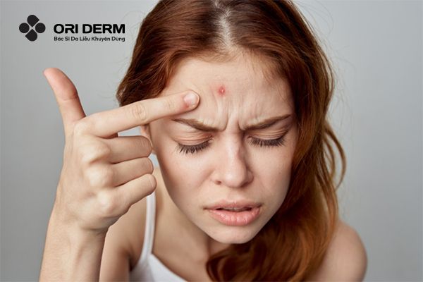Nguyên nhân nổi mụn viêm ở trán