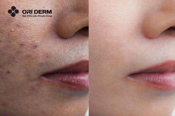 Vết Thâm Mụn Mãi Không Hết? Nguyên Nhân Và Cách Khắc Phục