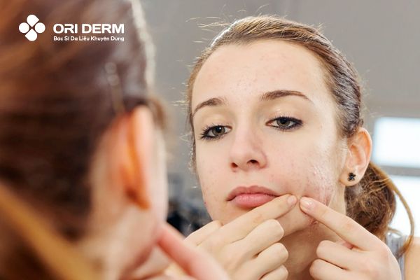 Nguyên nhân hình thành sẹo rỗ