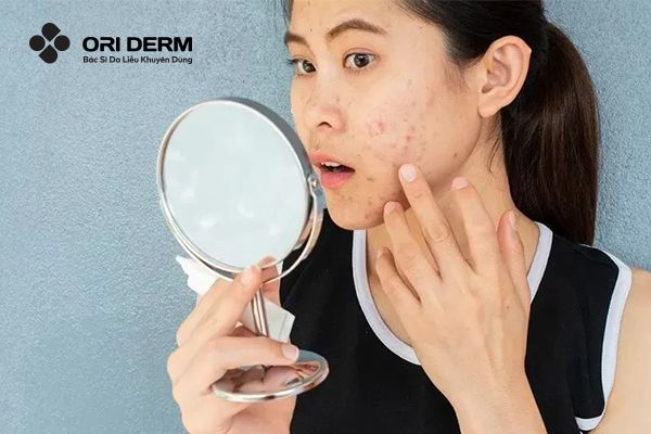 Nguyên nhân hình thành thâm mụn